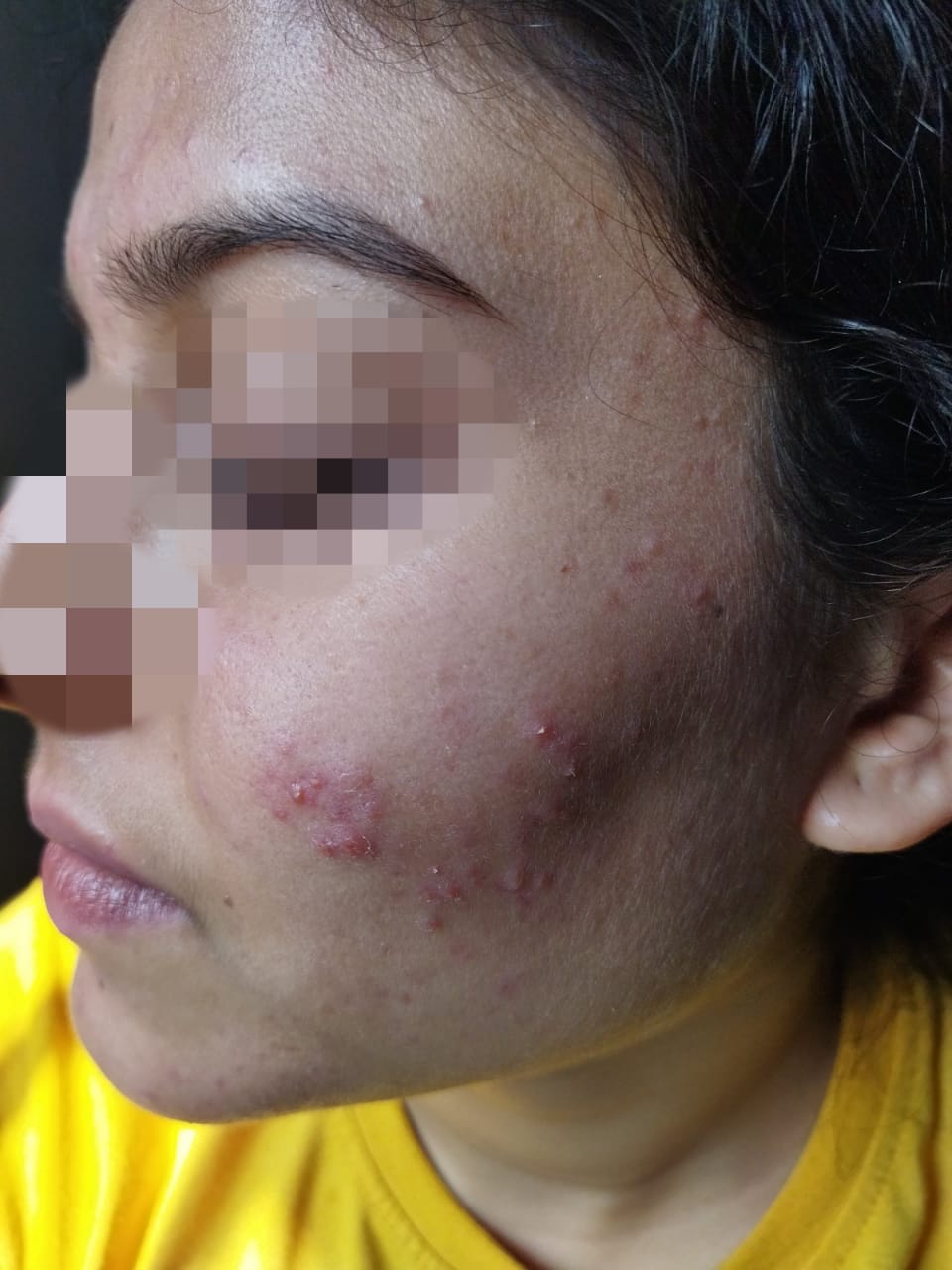 Why You Should Consult a Dermatologist for  Acne